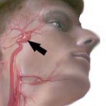stroke-6